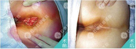 肛肠吻合器手术治混合痔前后